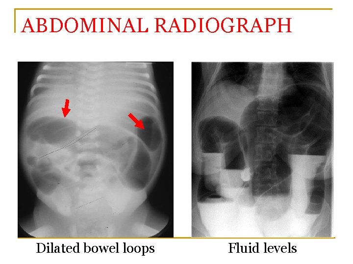 ABDOMINAL RADIOGRAPH Dilated bowel loops Fluid levels 