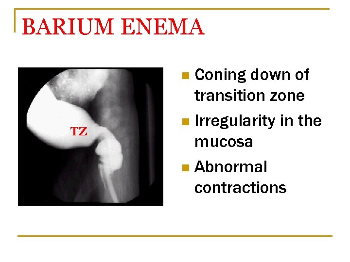 BARIUM ENEMA Coning down of transition zone n Irregularity in the mucosa n Abnormal
