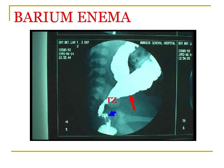 BARIUM ENEMA TZ 