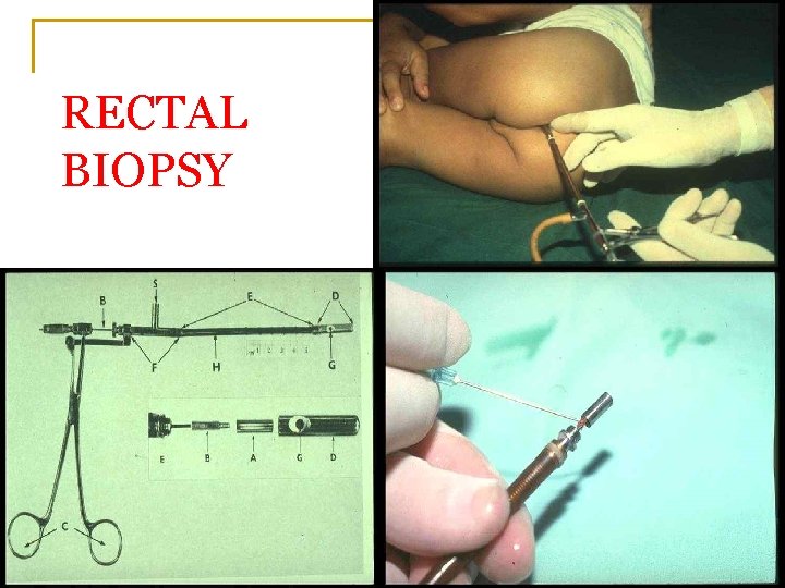 RECTAL BIOPSY 