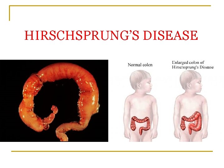 HIRSCHSPRUNG’S DISEASE 