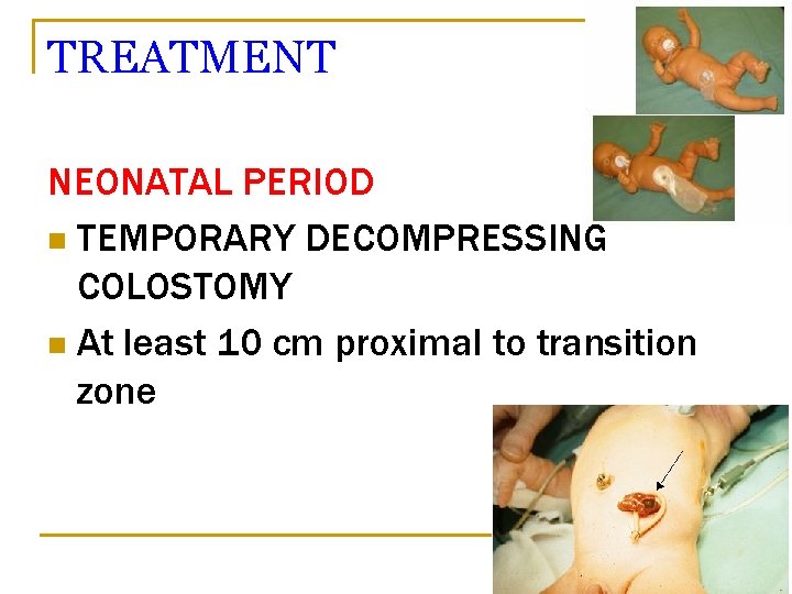 TREATMENT NEONATAL PERIOD n TEMPORARY DECOMPRESSING COLOSTOMY n At least 10 cm proximal to