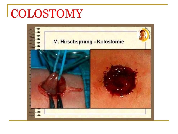 COLOSTOMY 