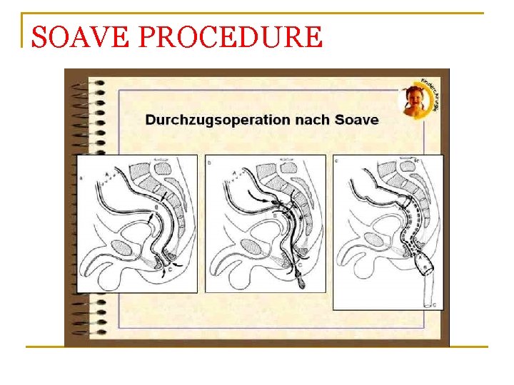 SOAVE PROCEDURE 