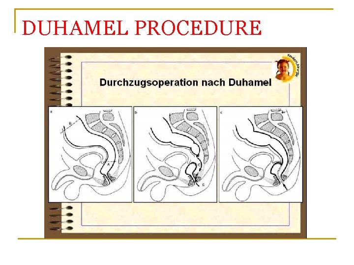 DUHAMEL PROCEDURE 