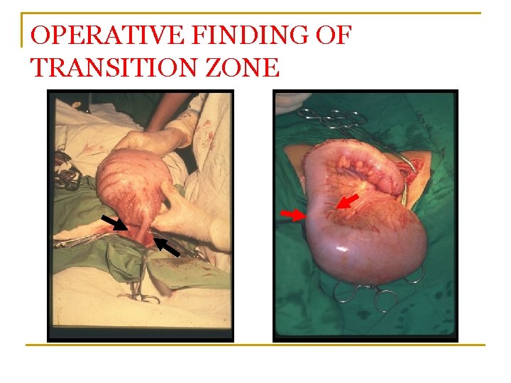 OPERATIVE FINDING OF TRANSITION ZONE 