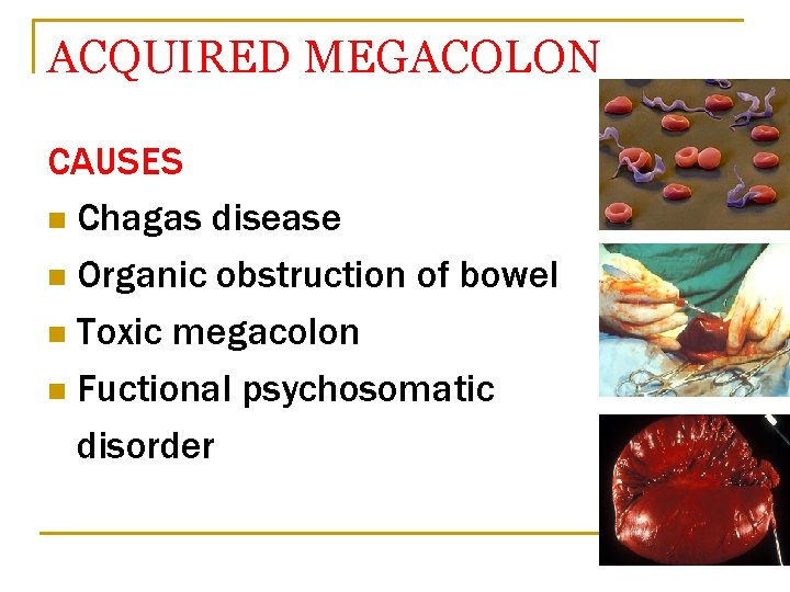 ACQUIRED MEGACOLON CAUSES n Chagas disease n Organic obstruction of bowel n Toxic megacolon