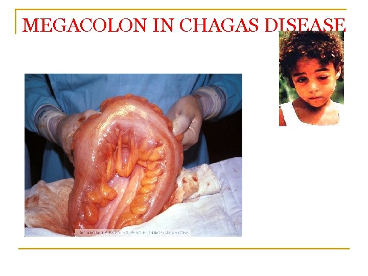 MEGACOLON IN CHAGAS DISEASE 