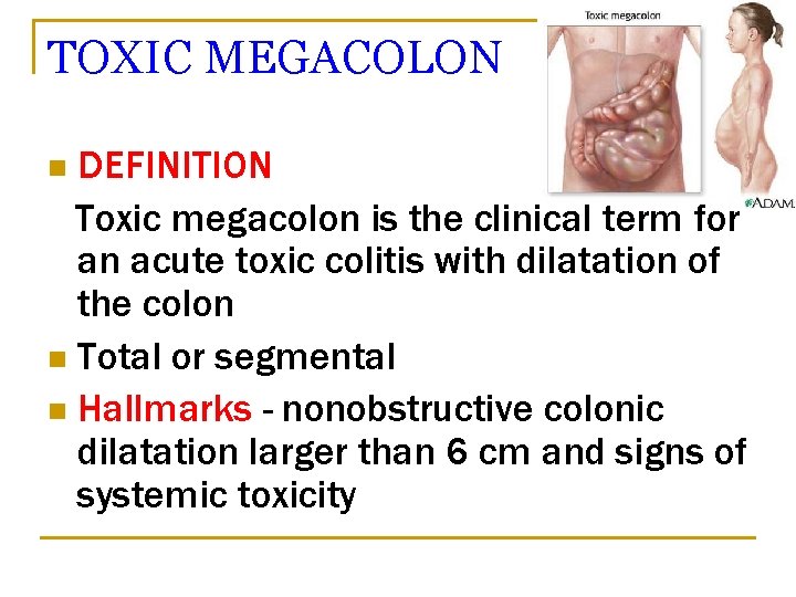 TOXIC MEGACOLON DEFINITION Toxic megacolon is the clinical term for an acute toxic colitis