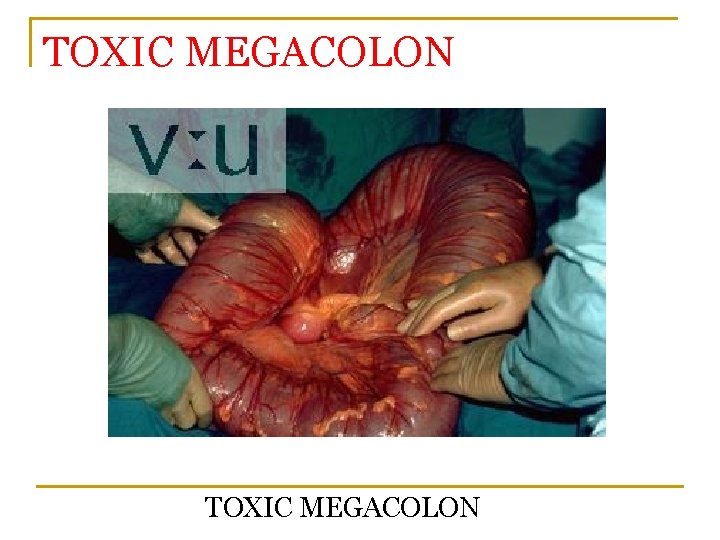 TOXIC MEGACOLON 