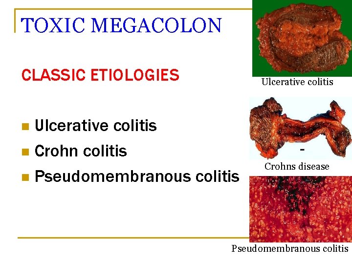 TOXIC MEGACOLON CLASSIC ETIOLOGIES Ulcerative colitis n Crohn colitis n Pseudomembranous colitis n Crohns