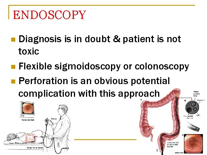 ENDOSCOPY Diagnosis is in doubt & patient is not toxic n Flexible sigmoidoscopy or