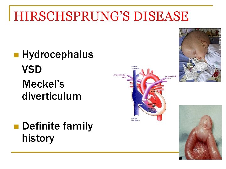 HIRSCHSPRUNG’S DISEASE n Hydrocephalus VSD Meckel’s diverticulum n Definite family history 