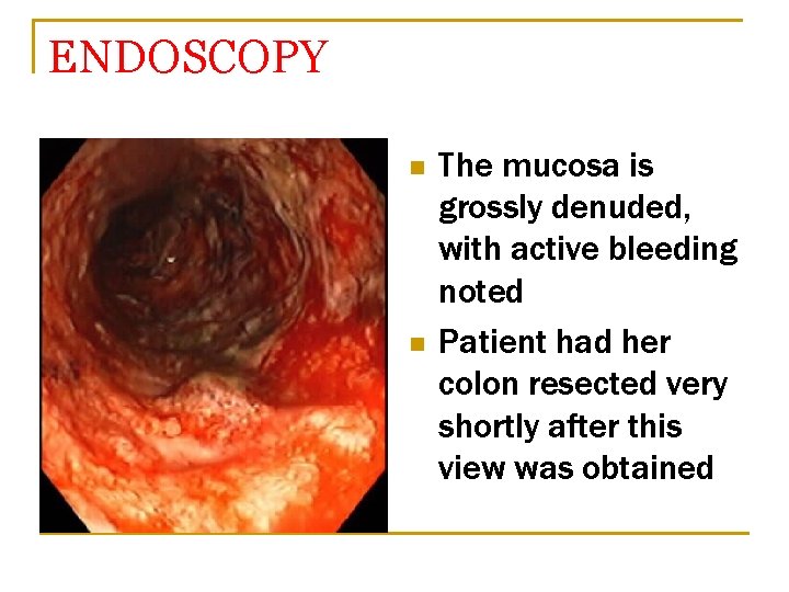 ENDOSCOPY n n The mucosa is grossly denuded, with active bleeding noted Patient had