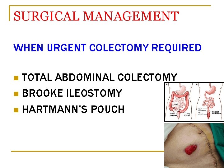 SURGICAL MANAGEMENT WHEN URGENT COLECTOMY REQUIRED TOTAL ABDOMINAL COLECTOMY n BROOKE ILEOSTOMY n HARTMANN’S
