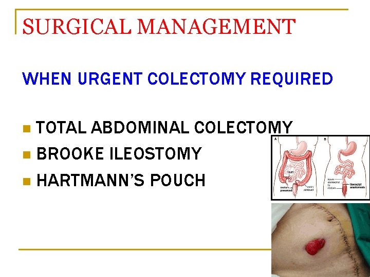 SURGICAL MANAGEMENT WHEN URGENT COLECTOMY REQUIRED TOTAL ABDOMINAL COLECTOMY n BROOKE ILEOSTOMY n HARTMANN’S