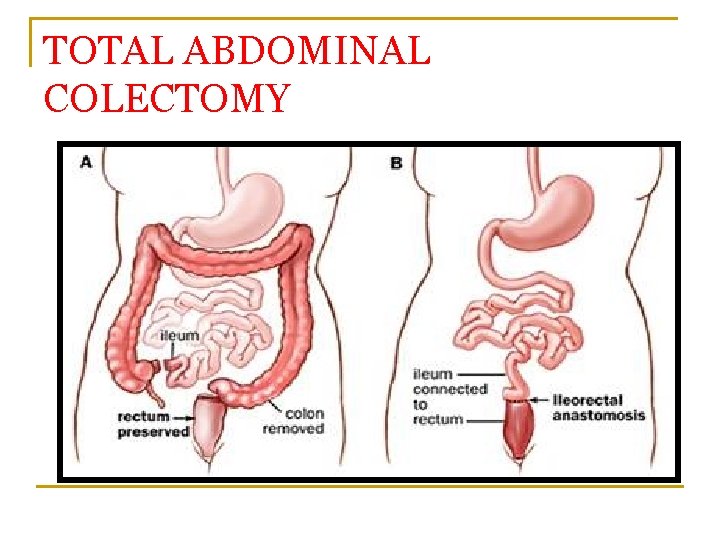 TOTAL ABDOMINAL COLECTOMY 