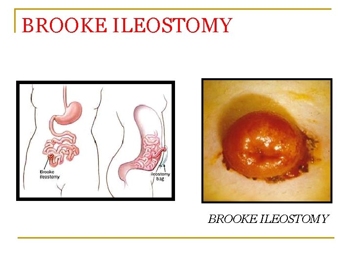 BROOKE ILEOSTOMY 