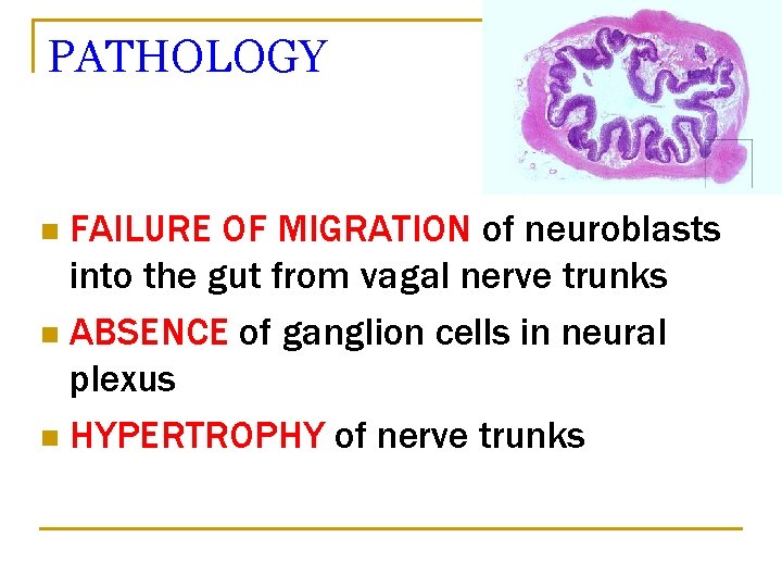 PATHOLOGY FAILURE OF MIGRATION of neuroblasts into the gut from vagal nerve trunks n