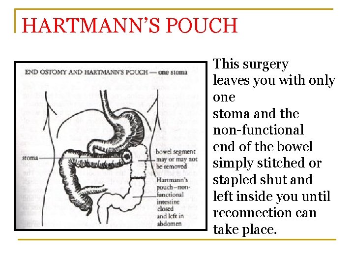 HARTMANN’S POUCH This surgery leaves you with only one stoma and the non-functional end