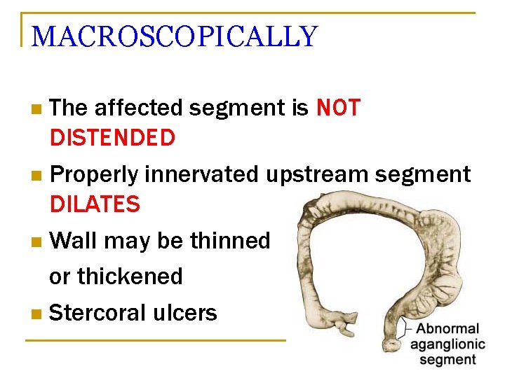 MACROSCOPICALLY The affected segment is NOT DISTENDED n Properly innervated upstream segment DILATES n
