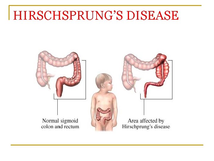 HIRSCHSPRUNG’S DISEASE 