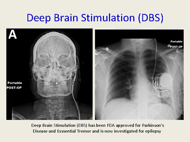 Deep Brain Stimulation (DBS) has been FDA approved for Parkinson’s Disease and Esssential Tremor Deep Brain Stimulation (DBS) has been FDA approved for Parkinson’s Disease and Esssential Tremor