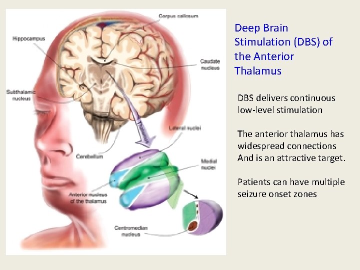 Deep Brain Stimulation (DBS) of the Anterior Thalamus DBS delivers continuous low-level stimulation The Deep Brain Stimulation (DBS) of the Anterior Thalamus DBS delivers continuous low-level stimulation The