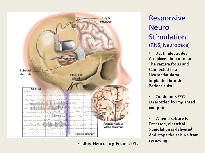 Responsive Neuro Stimulation (RNS, Neuropace) • Depth electrodes Are placed into or near The Responsive Neuro Stimulation (RNS, Neuropace) • Depth electrodes Are placed into or near The