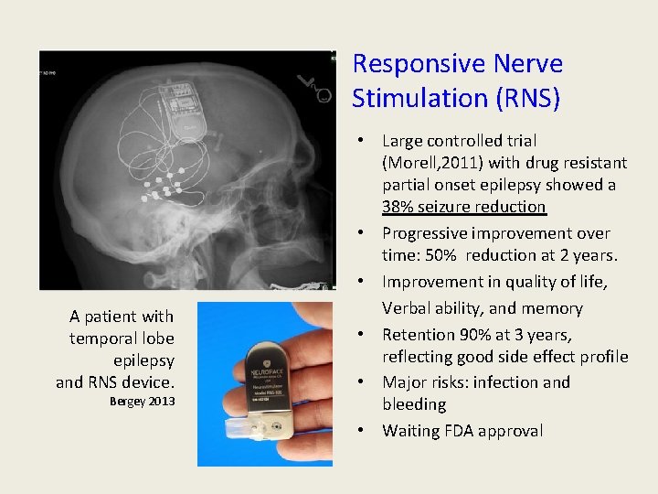 Responsive Nerve Stimulation (RNS) A patient with temporal lobe epilepsy and RNS device. Bergey Responsive Nerve Stimulation (RNS) A patient with temporal lobe epilepsy and RNS device. Bergey