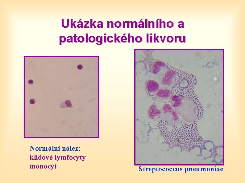 Ukázka normálního a patologického likvoru Normální nález: klidové lymfocyty monocyt Streptococcus pneumoniae 