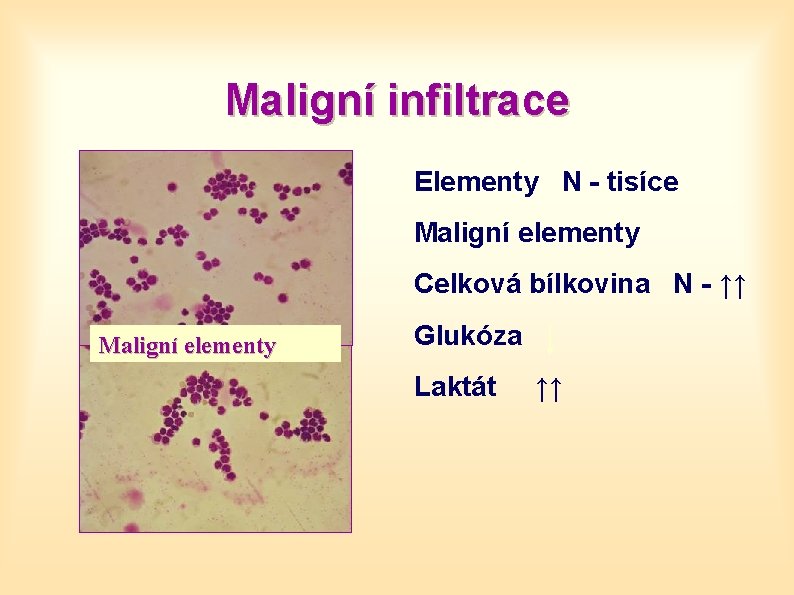 Maligní infiltrace Elementy N - tisíce Maligní elementy Celková bílkovina N - ↑↑ Maligní