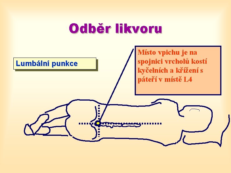 Odběr likvoru Lumbální punkce Místo vpichu je na spojnici vrcholů kostí kyčelních a křížení