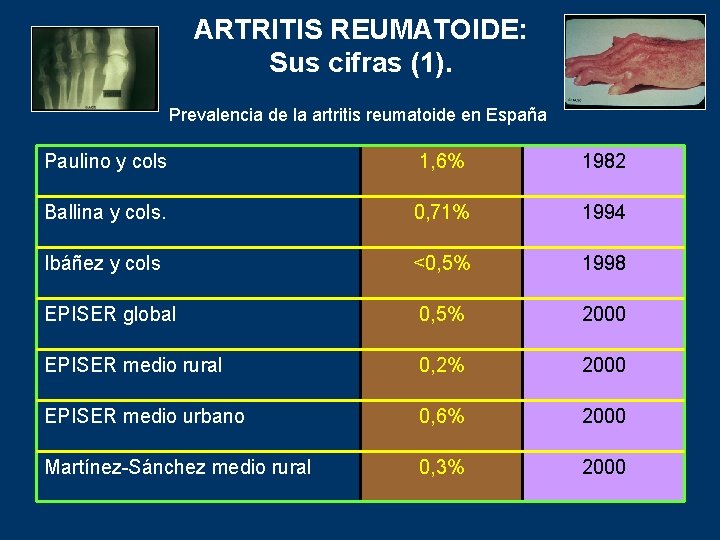 ARTRITIS REUMATOIDE: Sus cifras (1). Prevalencia de la artritis reumatoide en España Paulino y