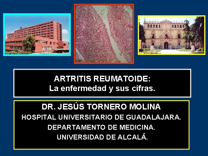 ARTRITIS REUMATOIDE: La enfermedad y sus cifras. DR. JESÚS TORNERO MOLINA HOSPITAL UNIVERSITARIO DE
