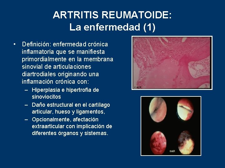 ARTRITIS REUMATOIDE: La enfermedad (1) • Definición: enfermedad crónica inflamatoria que se manifiesta primordialmente