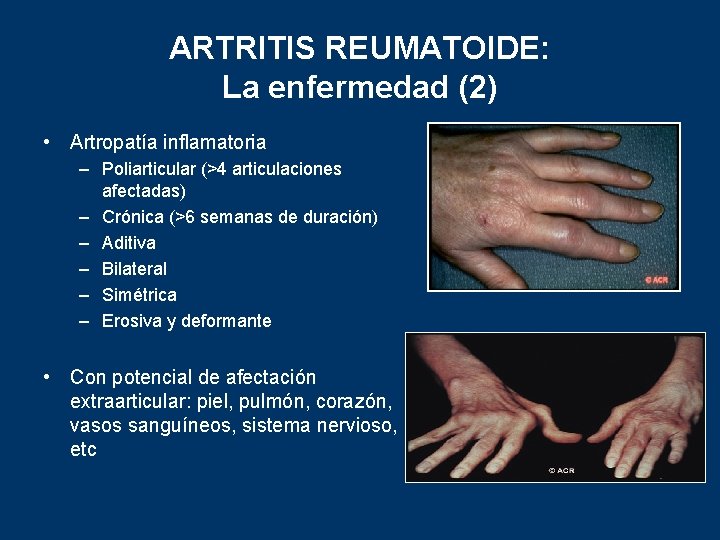 ARTRITIS REUMATOIDE: La enfermedad (2) • Artropatía inflamatoria – Poliarticular (>4 articulaciones afectadas) –