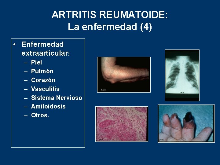 ARTRITIS REUMATOIDE: La enfermedad (4) • Enfermedad extraarticular: – – – – Piel Pulmón