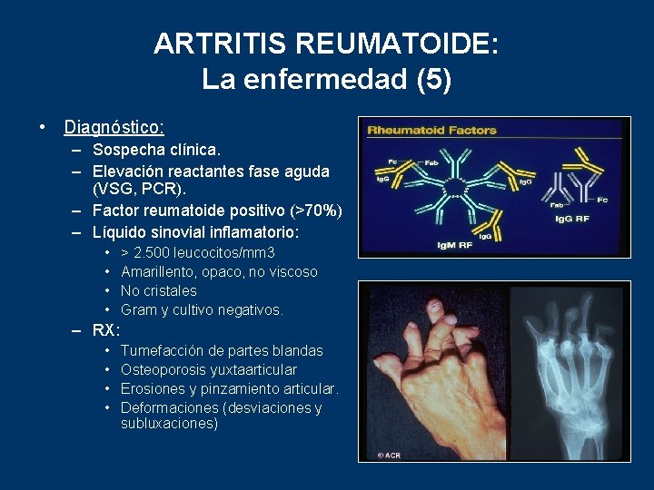 ARTRITIS REUMATOIDE: La enfermedad (5) • Diagnóstico: – Sospecha clínica. – Elevación reactantes fase
