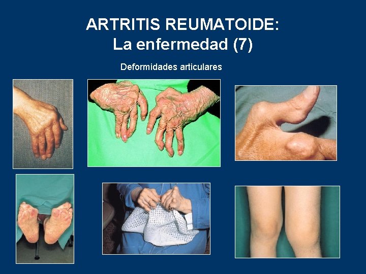 ARTRITIS REUMATOIDE: La enfermedad (7) Deformidades articulares 