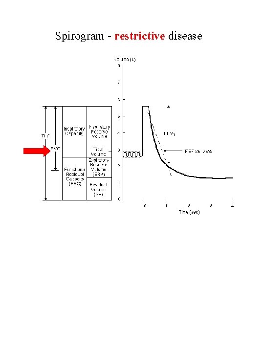 Spirogram - restrictive disease 