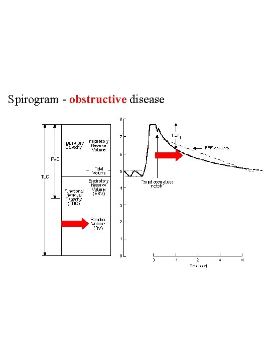 Spirogram - obstructive disease 