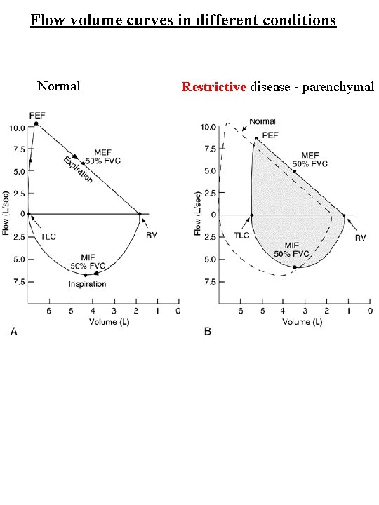 Flow volume curves in different conditions Normal Restrictive disease - parenchymal 