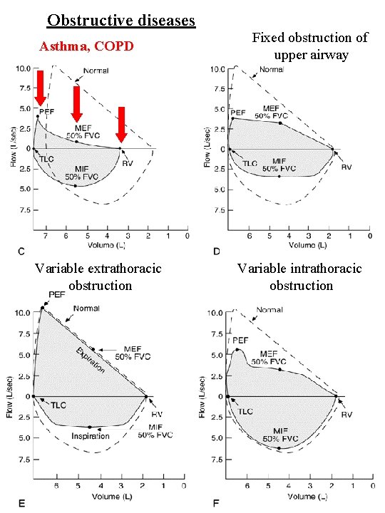 Obstructive diseases Asthma, COPD Variable extrathoracic obstruction Fixed obstruction of upper airway Variable intrathoracic