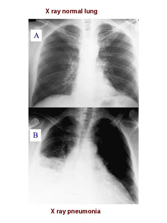 X ray normal lung X ray pneumonia 