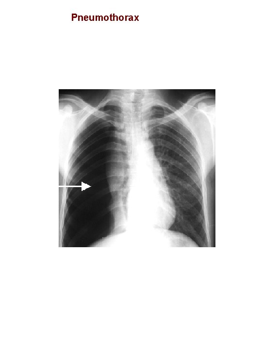 Pneumothorax 