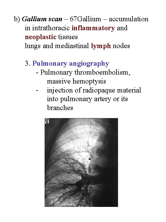 b) Gallium scan – 67 Gallium – accumulation in intrathoracic inflammatory and neoplastic tissues