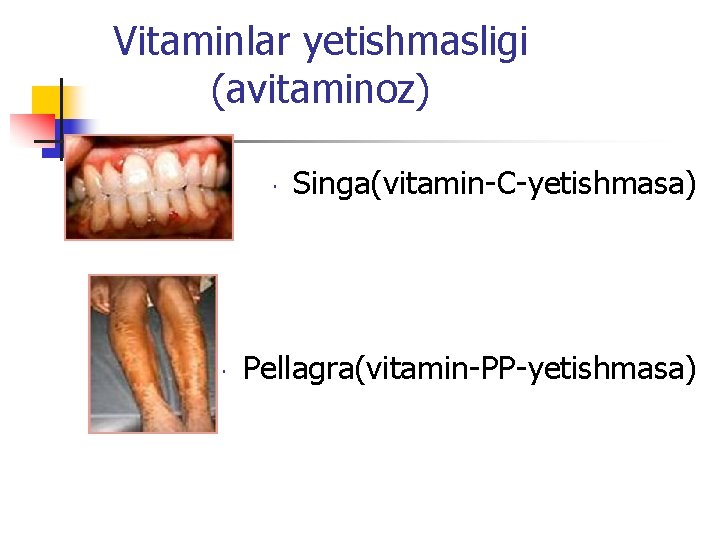 Vitaminlar yetishmasligi (avitaminoz) Singa(vitamin-C-yetishmasa) Pellagra(vitamin-PP-yetishmasa) 