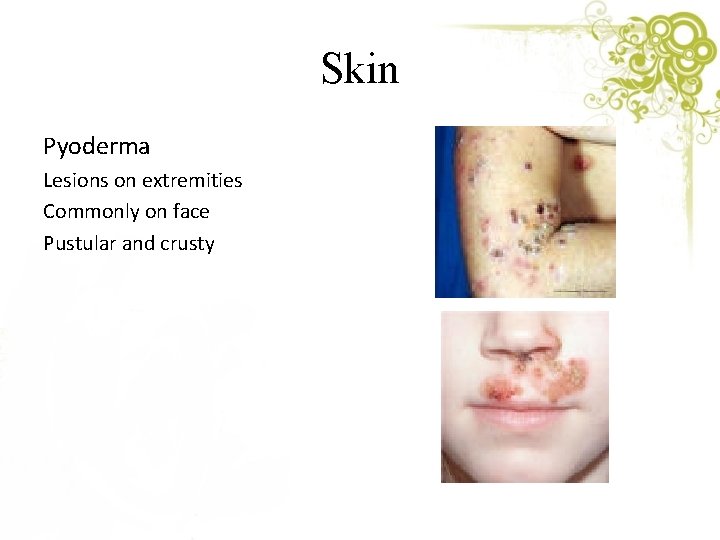 Skin Pyoderma Lesions on extremities Commonly on face Pustular and crusty 