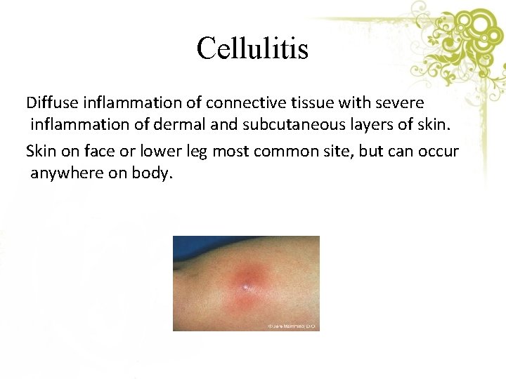 Cellulitis Diffuse inflammation of connective tissue with severe inflammation of dermal and subcutaneous layers